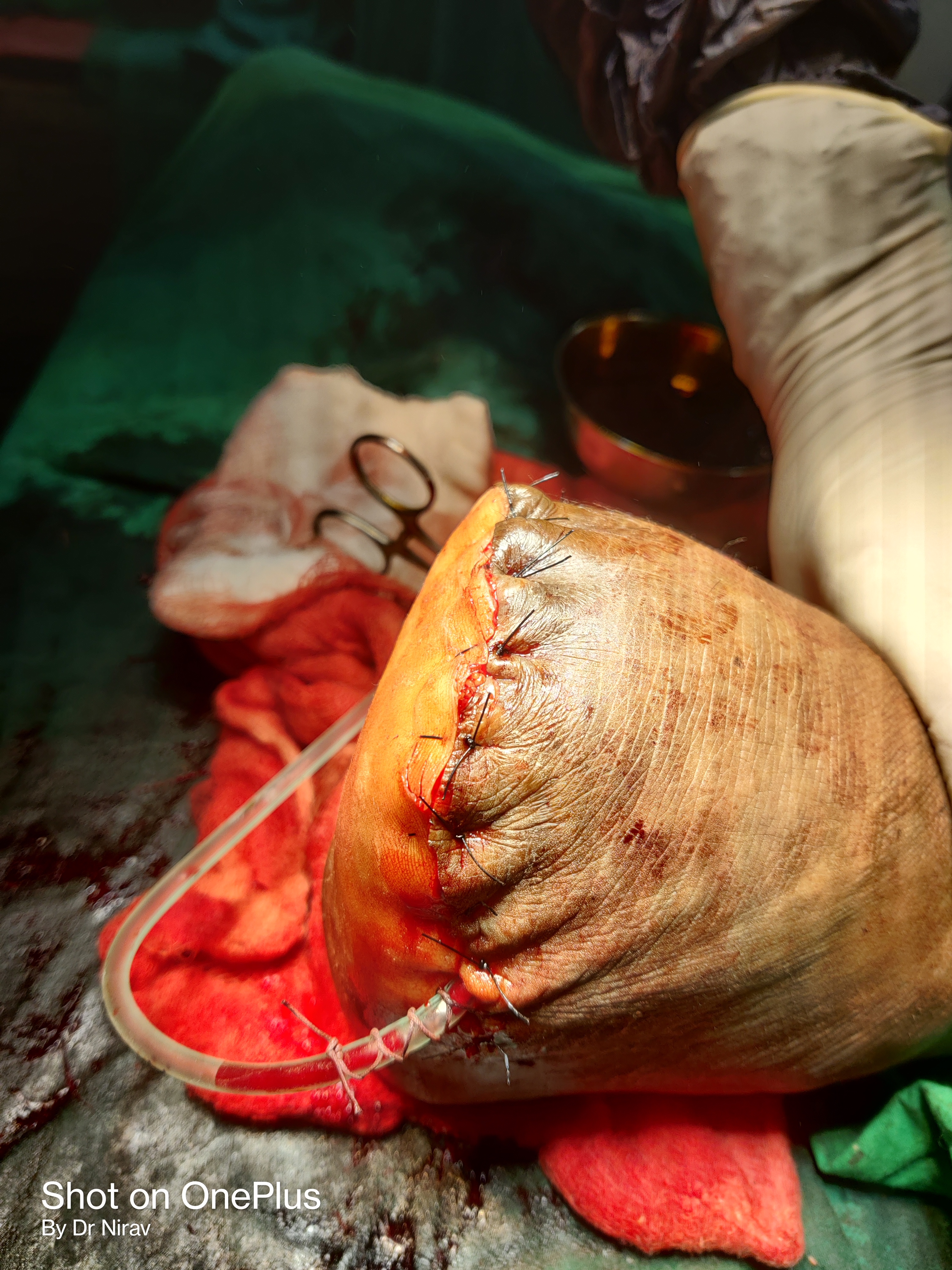 Amputation Surgery illustration