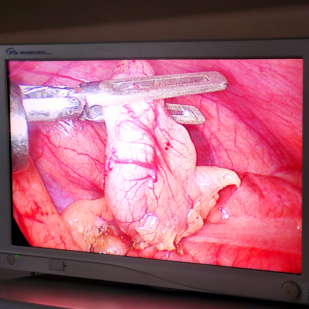 Appendix Surgery illustration