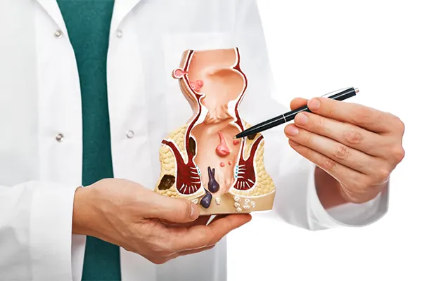 Fissure & Fistula Treatment illustration