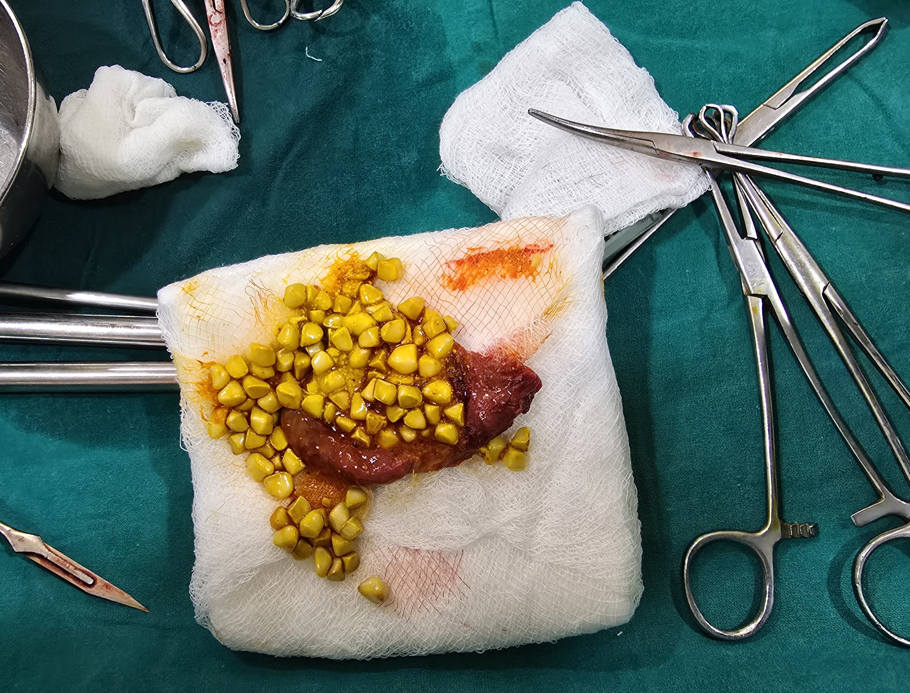 Gallbladder Surgery illustration