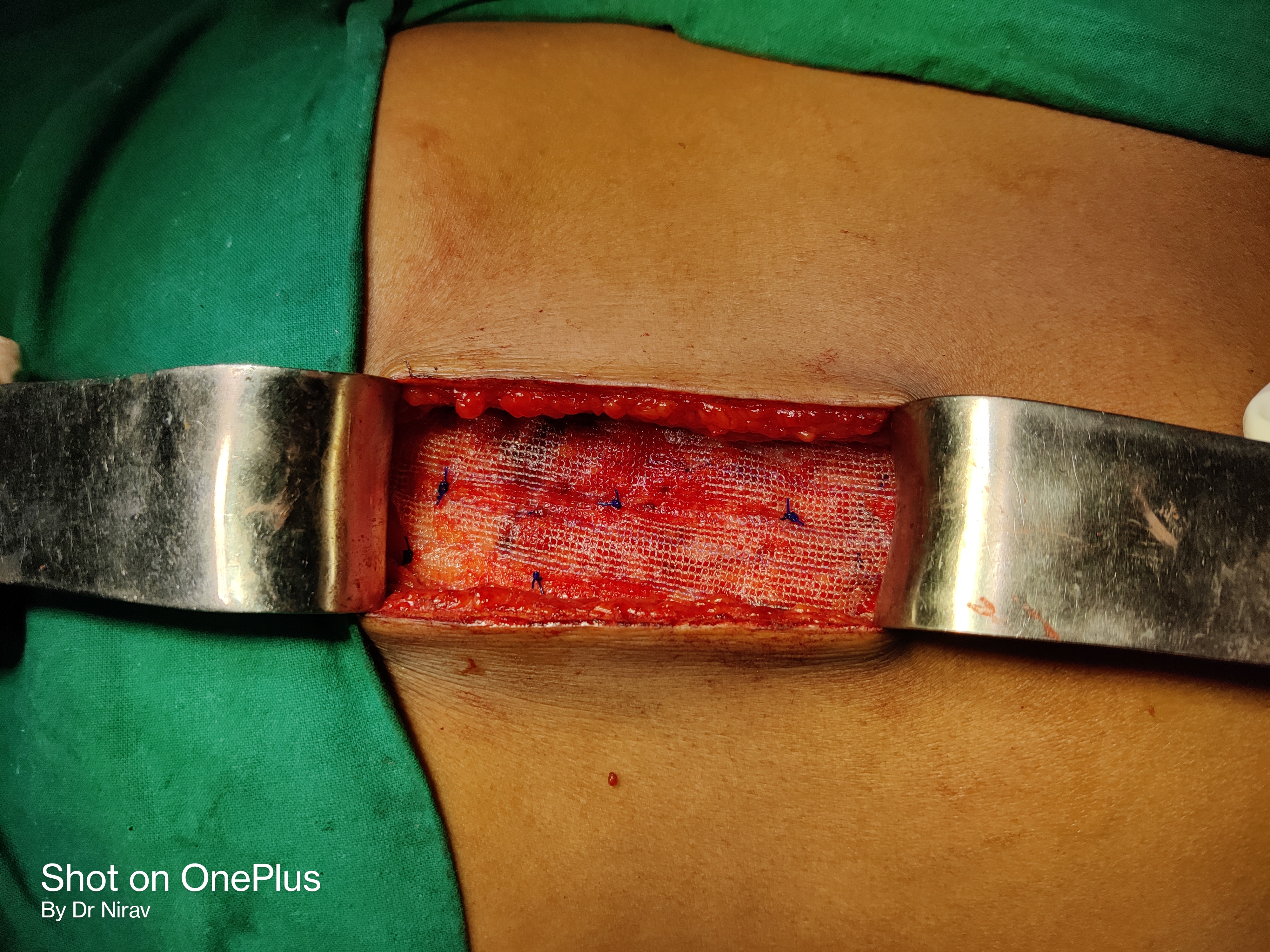 Hernioplasty illustration