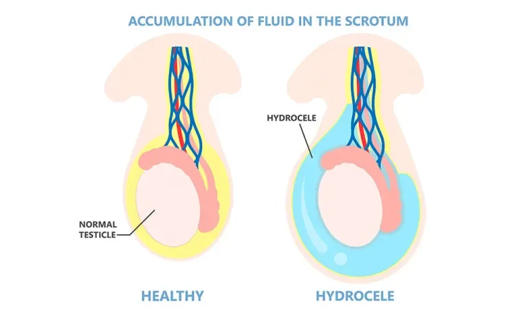 Hydrocele & Undescended testis Surgery illustration
